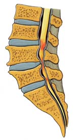 stenosis-BB.jpg