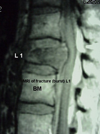 mri_burstfracture-BB.jpg