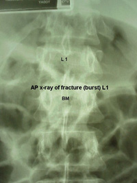 xray_burstfracture-BB.jpg