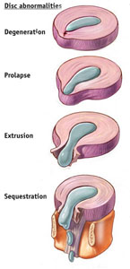 Disc Extrusion