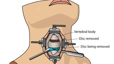 Anterior Cervical Disc Fusion