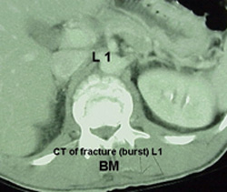 ct_burstfracture-BB.jpg