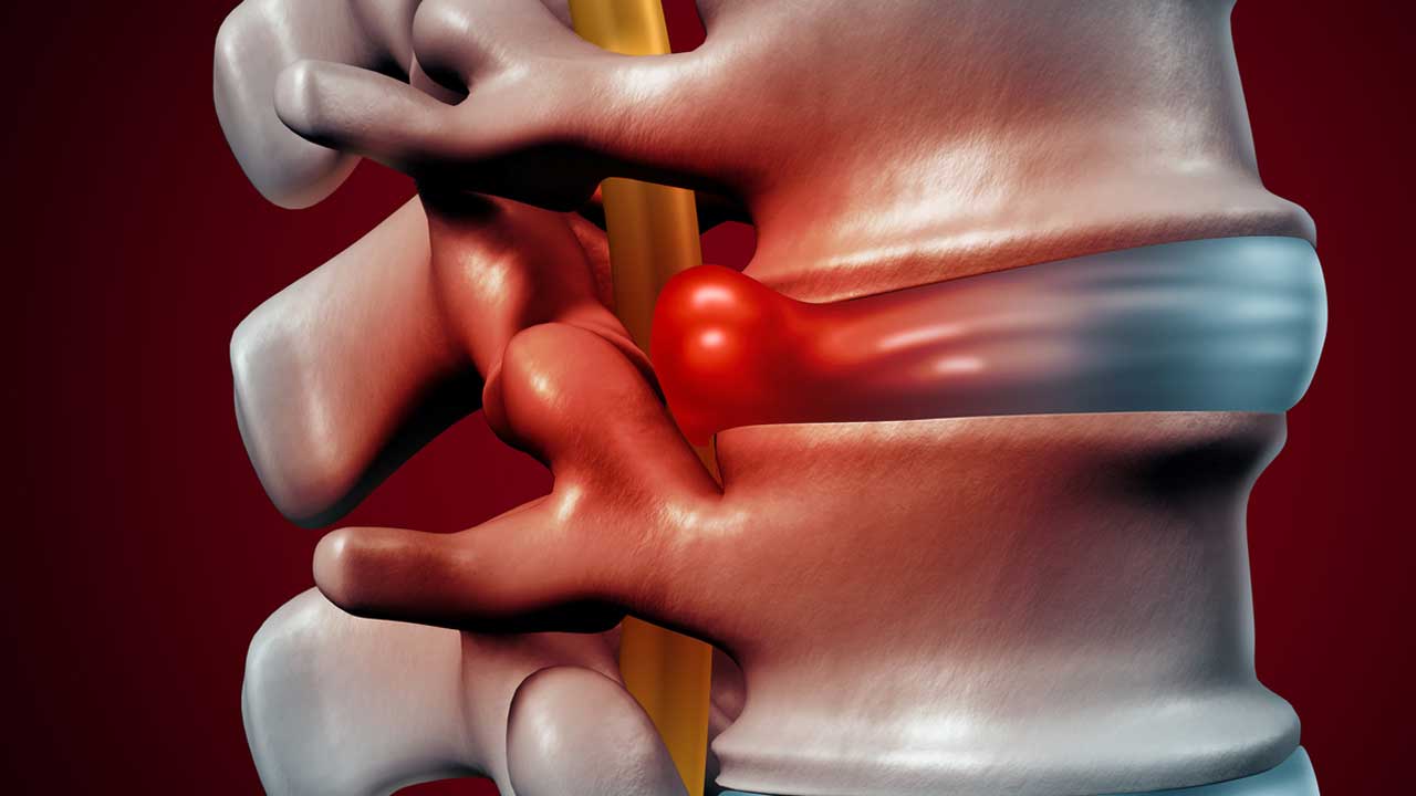 Vertebral Disc Disorders The Herniated Disc