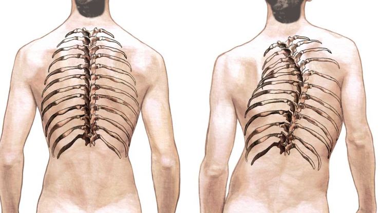 scoliosis-illustration.jpg