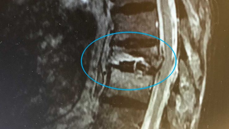 thoracic-fracture.jpg