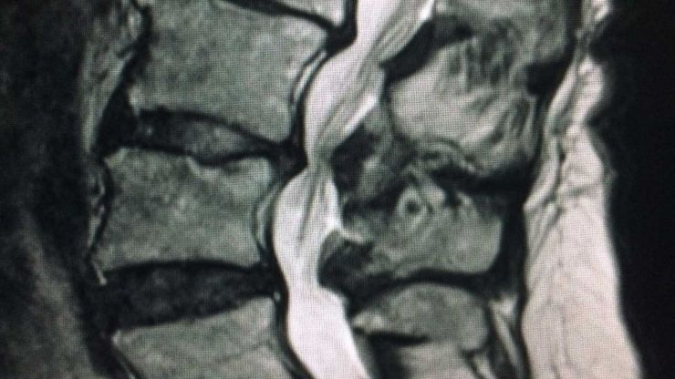 Severe Spinal Stenosis